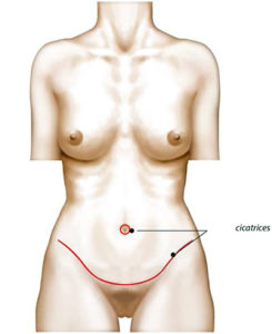 Chirurgie du ventre ou abdominoplastie à Arras - Dr Mortier